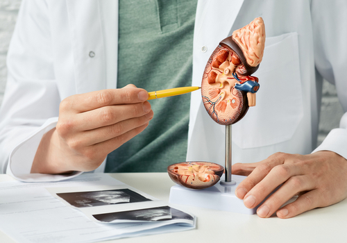 Kidney Stones.